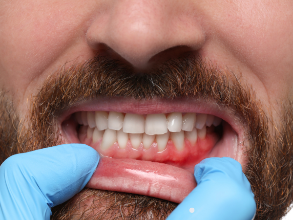 Causes of Receding Gums