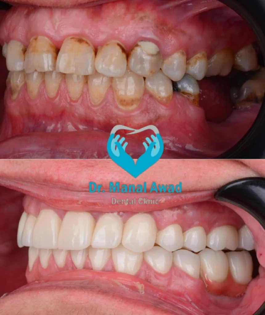 Dental Implant In Jordan 2