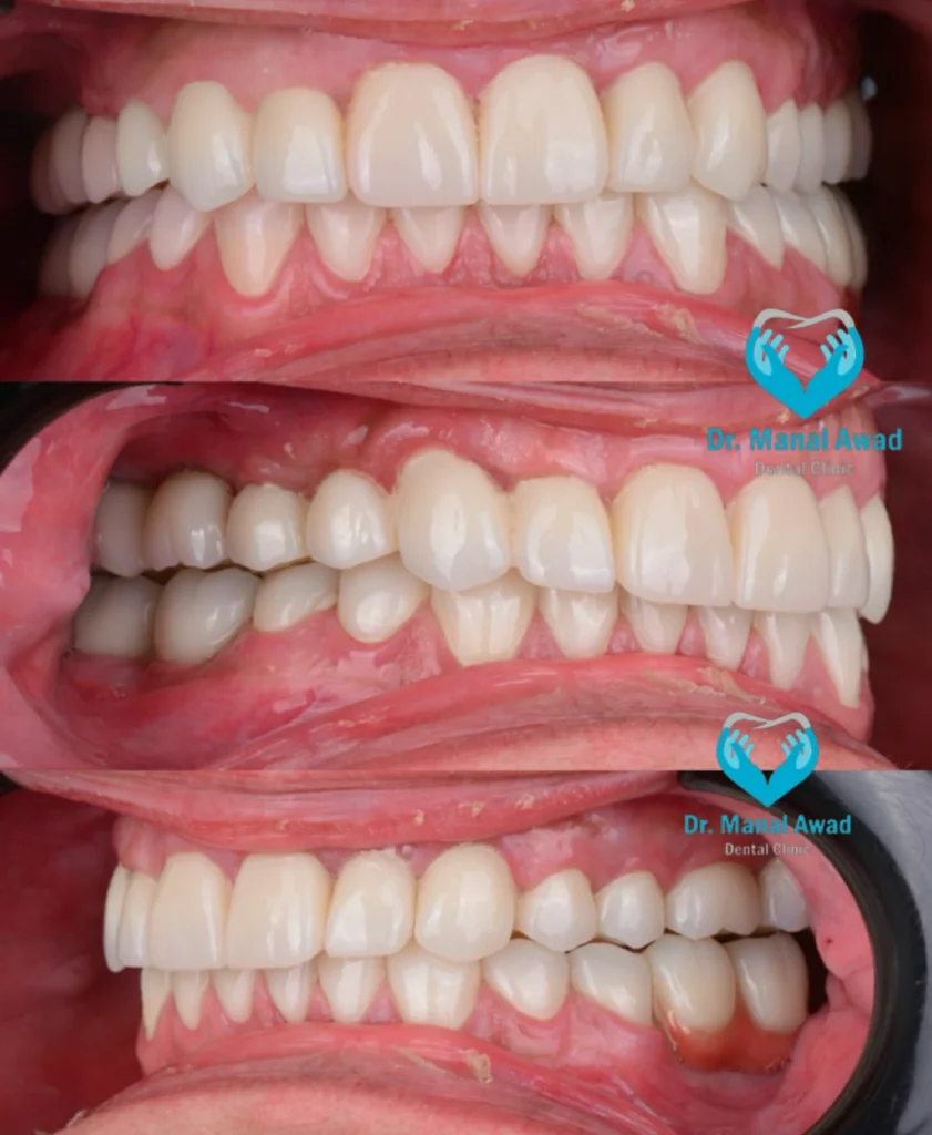 Dental Implant In Jordan 5