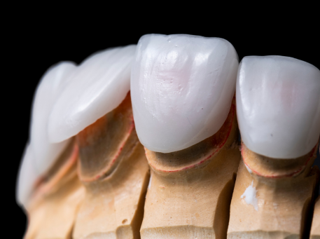 Dental Veneer Wear