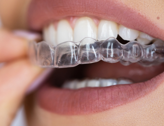 Clear Aligners in amman (1)